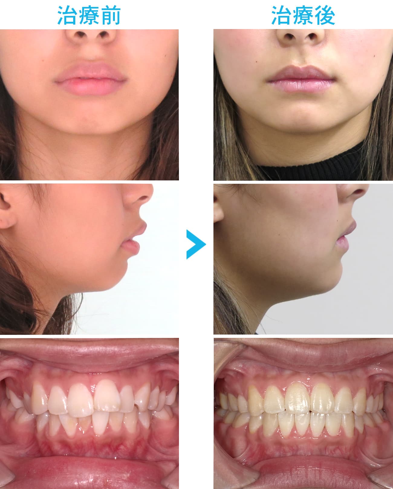 矯正 後 出っ歯 に なっ た