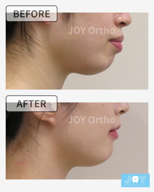 横顔のbefore/after：口ゴボ・口が閉じにくい症例の矯正治療前後、横顔とEラインの変化 症例3