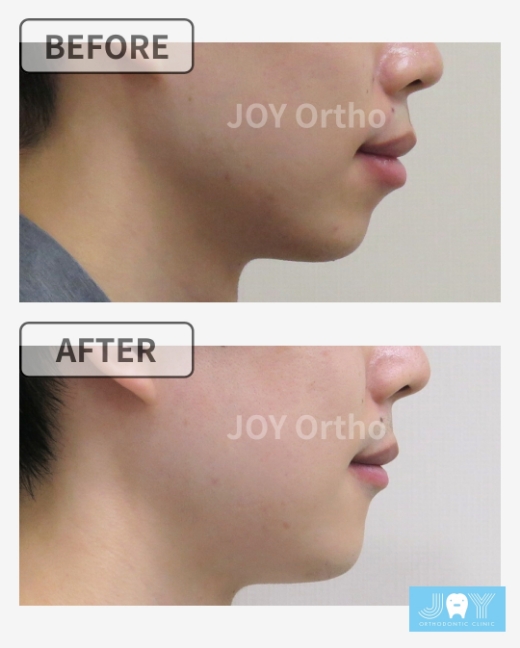 横顔のbefore/after：口ゴボ・口が閉じにくい症例の矯正治療前後、横顔とEラインの変化 症例4