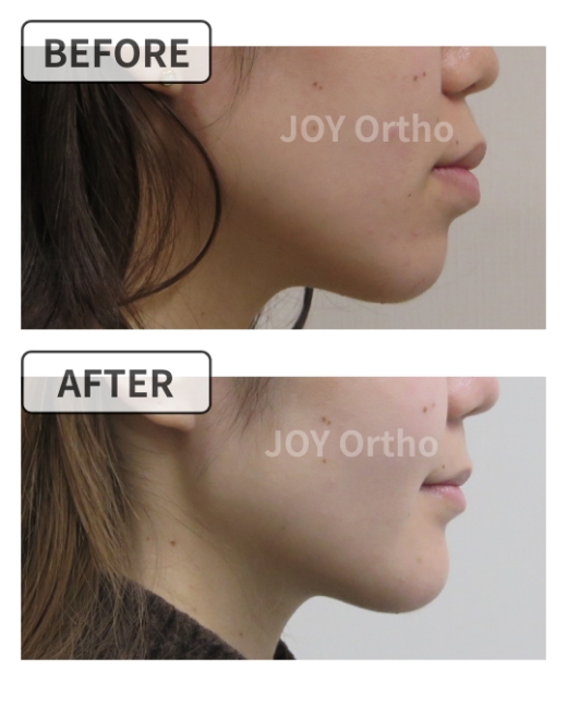 横顔のbefore/after：口ゴボ・口が閉じにくい症例の矯正治療前後、横顔とEラインの変化 症例5