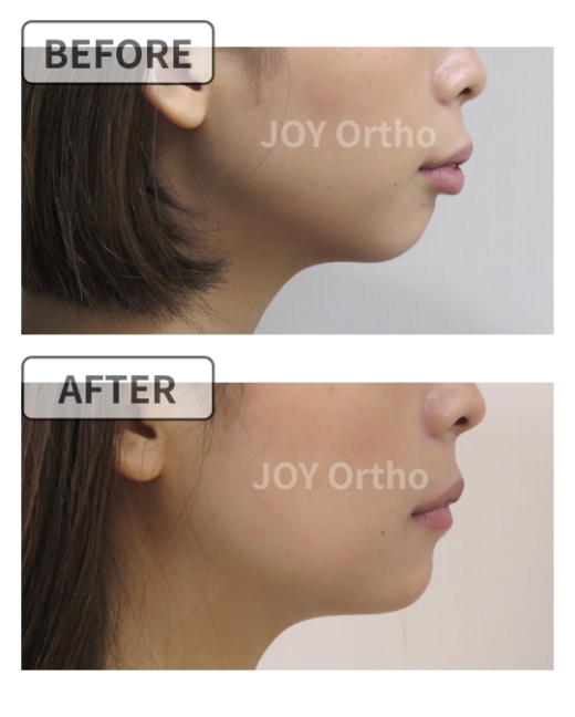 横顔のbefore/after：口ゴボ・口が閉じにくい症例の矯正治療前後、横顔とEラインの変化 症例7