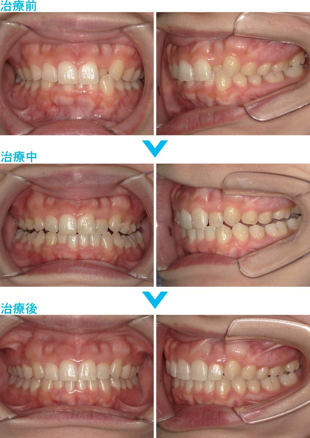 マウスピース矯正症例写真