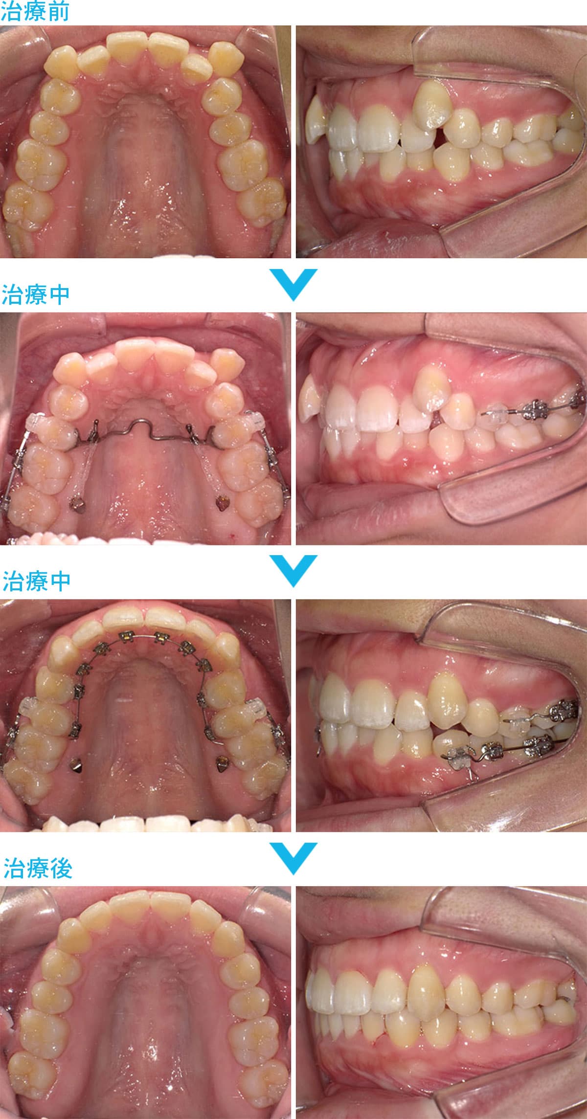 非抜歯の症例治療の比較