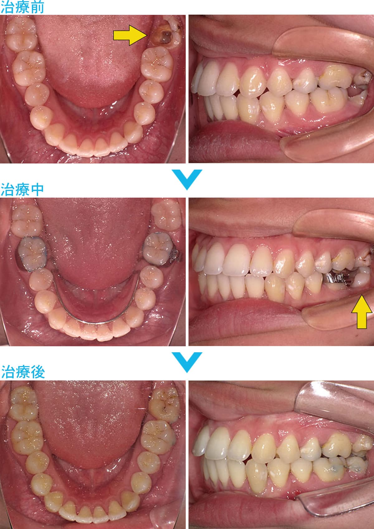 ブリッジ・インプラント・入れ歯を避けた治療の比較