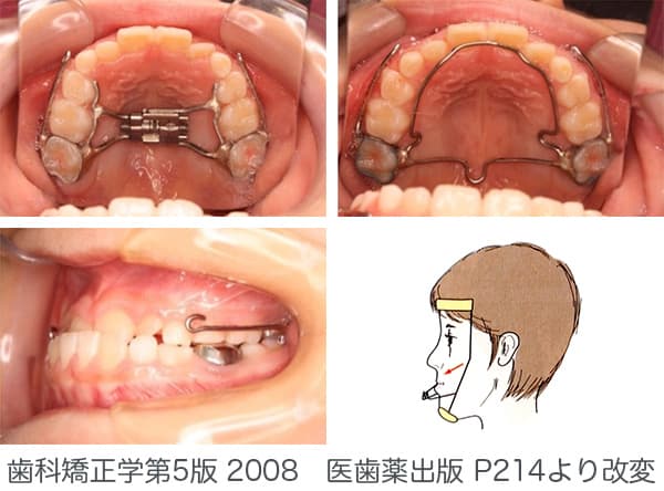 子供 歯科 矯正 顎 を 広げる