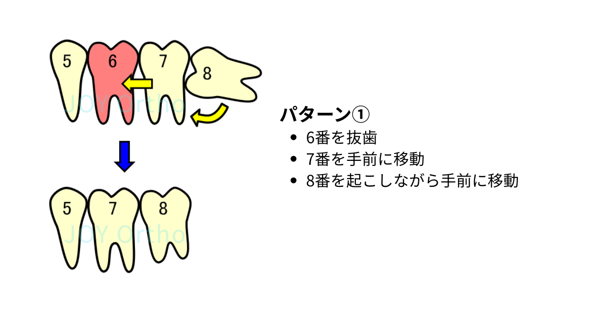 下顎6番を抜歯後、7番と親知らず（8番）を利用してインプラントを回避する矯正治療のパターン図①