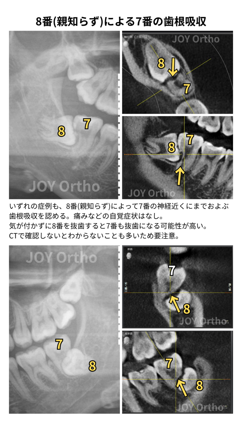 JOY矯正歯科クリニックによるCT診断で7番歯根吸収を評価し親知らずを安易に抜かない重要性の図解