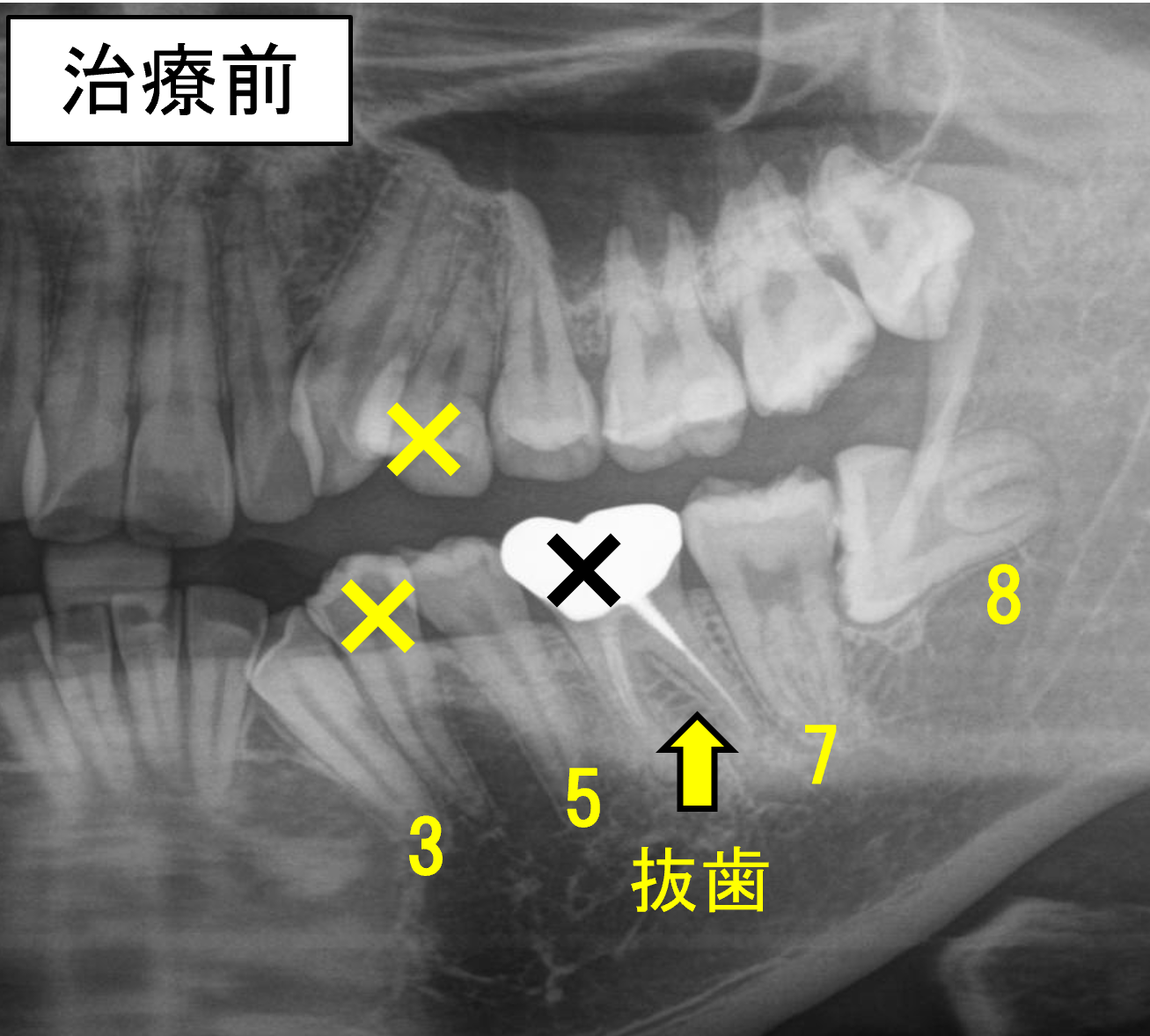 治療開始前のレントゲン写真。左下6番は保存困難で、親知らずは横向きに埋伏している。