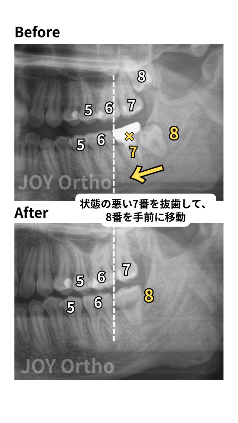 JOY矯正歯科クリニック 症例7 治療前後のレントゲンの比較。左下7番が根管治療歯で状態不良、8番が埋伏。治療後は状態の悪い左下7番を抜歯し、健全な左下8番を排列