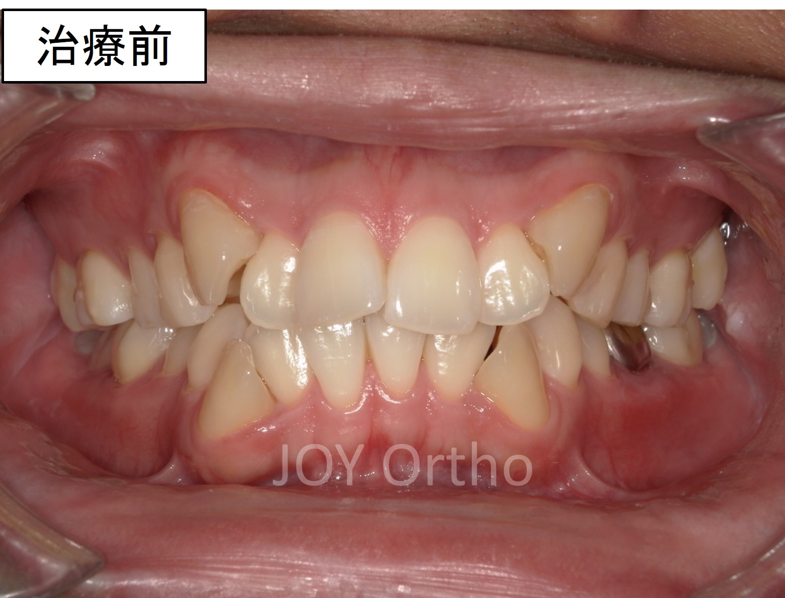 下顎6番抜歯前の口腔内写真。左下6番は保存困難で、親知らずは横向きに埋伏している
