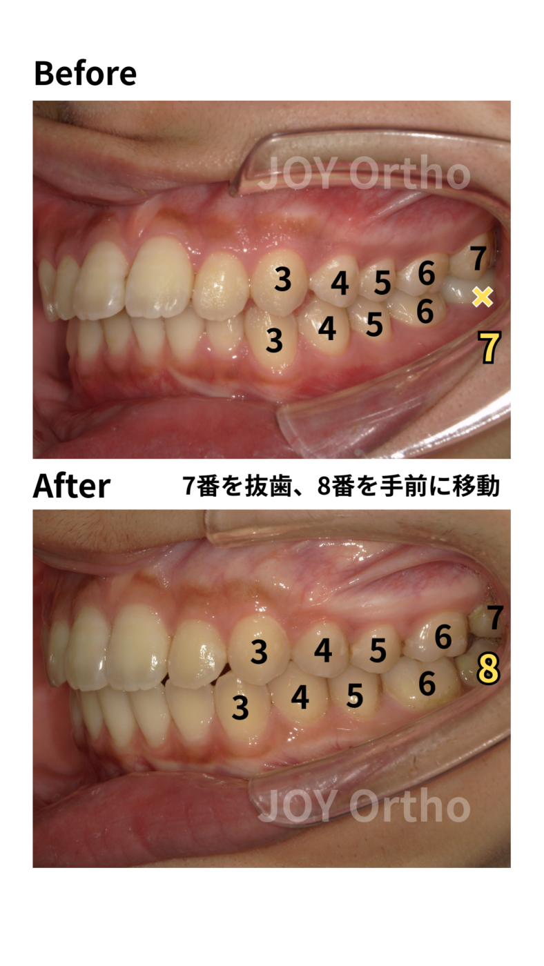 JOY矯正歯科クリニック 症例7 治療前後の左側口腔内写真の比較。左下7番が抜歯され、左下8番が排列されている。
親知らずの移動と咬合再構成