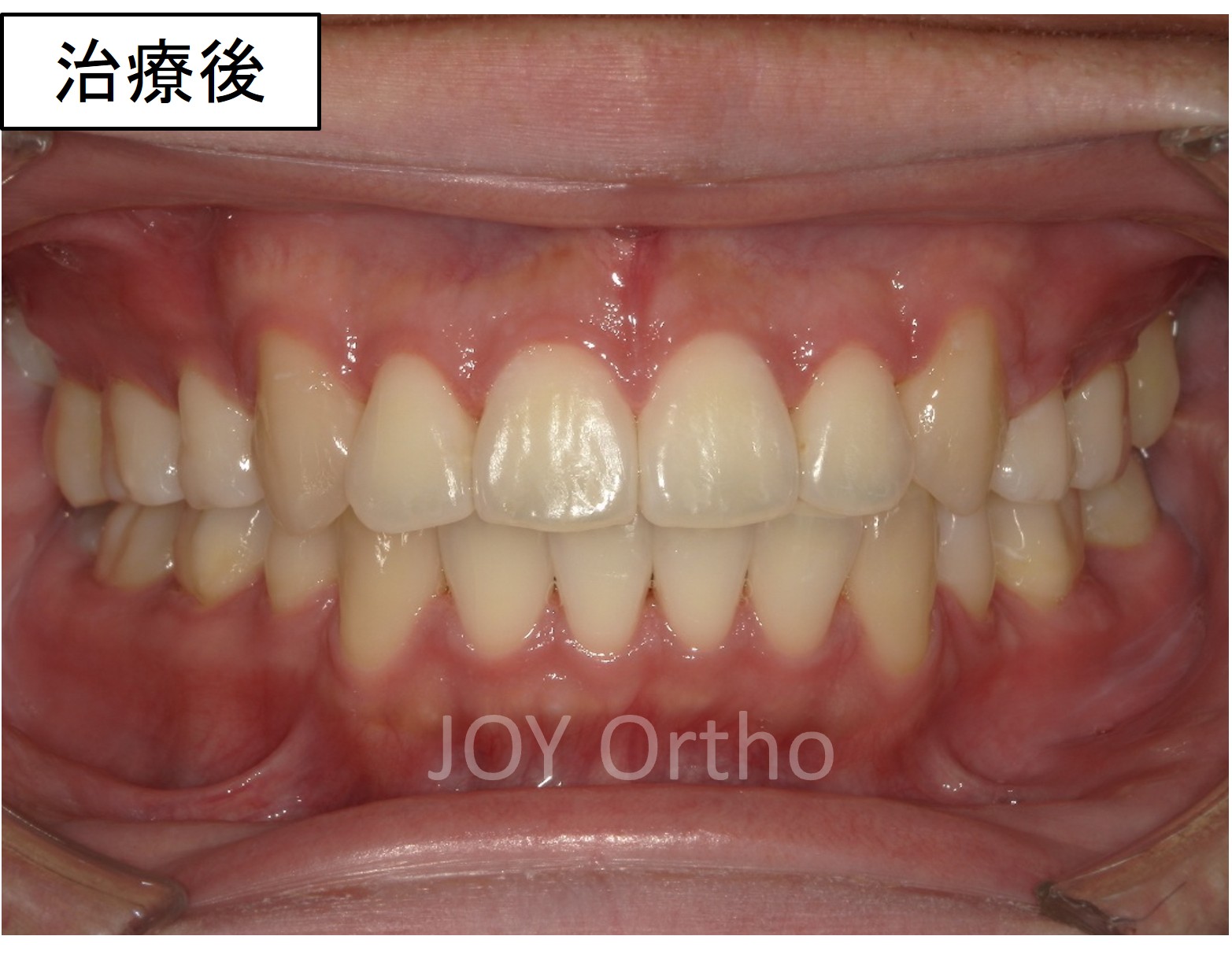 下顎6番抜歯後、7番と親知らずを利用してスペースを閉鎖し、インプラントを回避した治療後の口腔内写真
