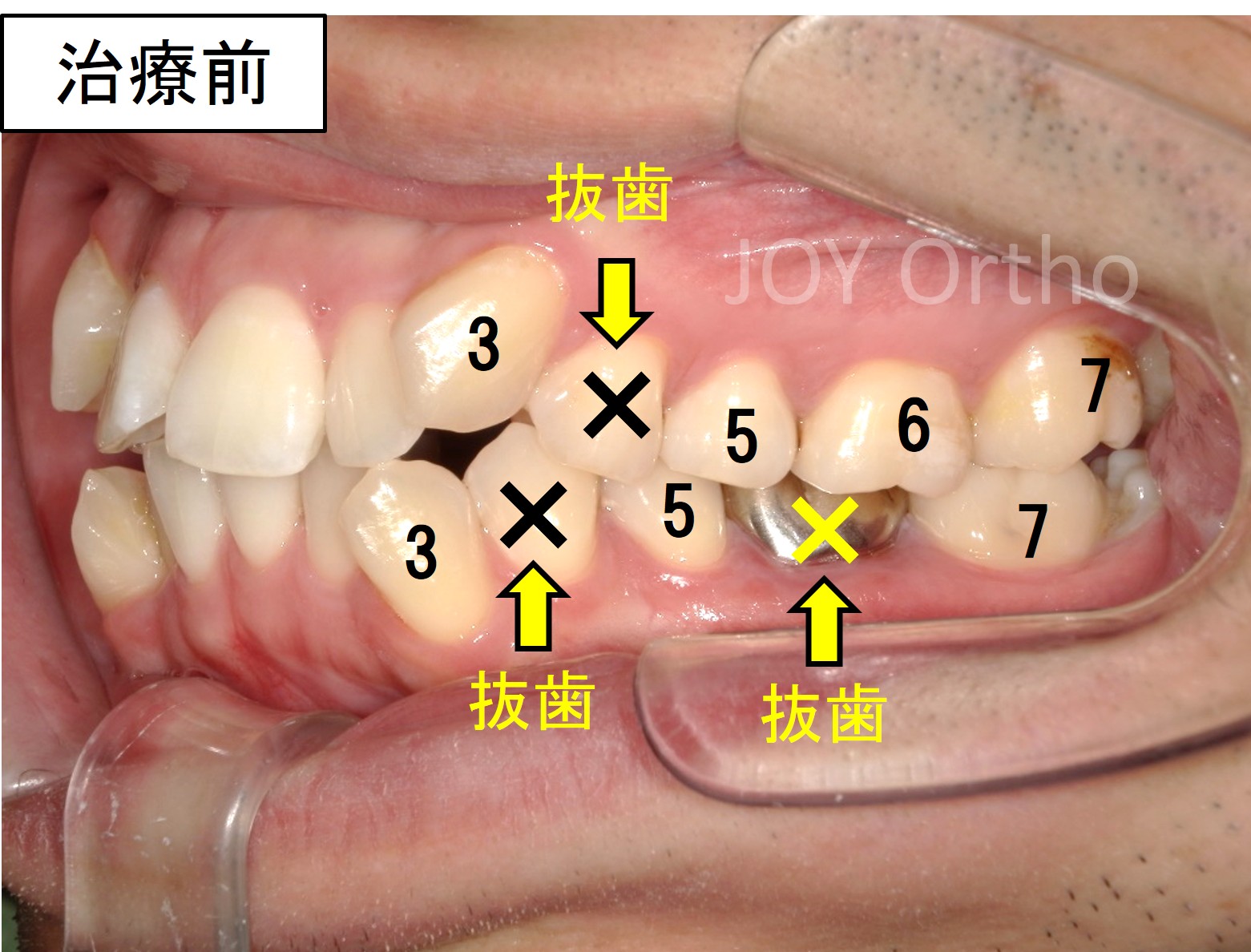 下顎6番抜歯前の口腔内写真。左下6番は保存困難で、親知らずは横向きに埋伏している