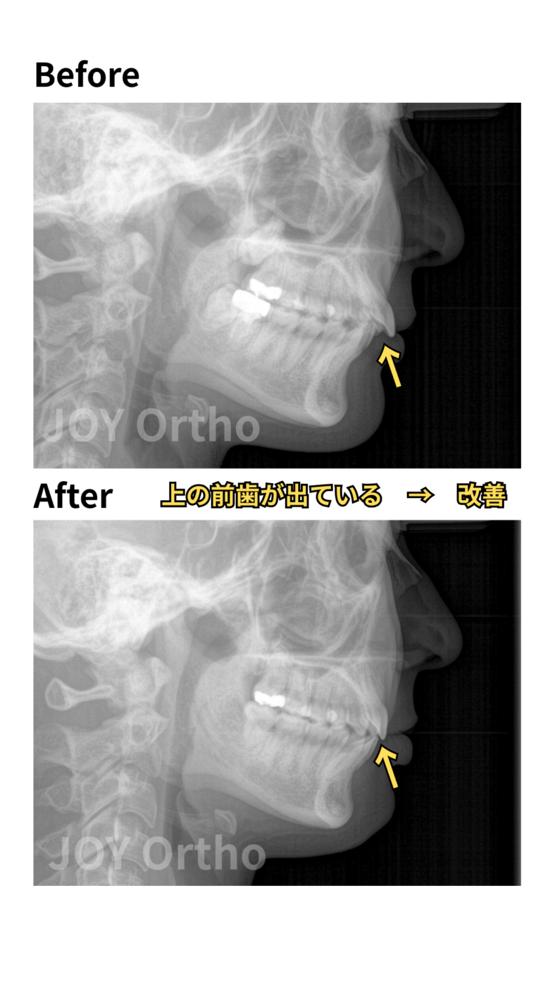 JOY矯正歯科クリニック 症例7 治療前後のレントゲン(側面セファログラム)の比較。非抜歯で、上顎前突が改善。