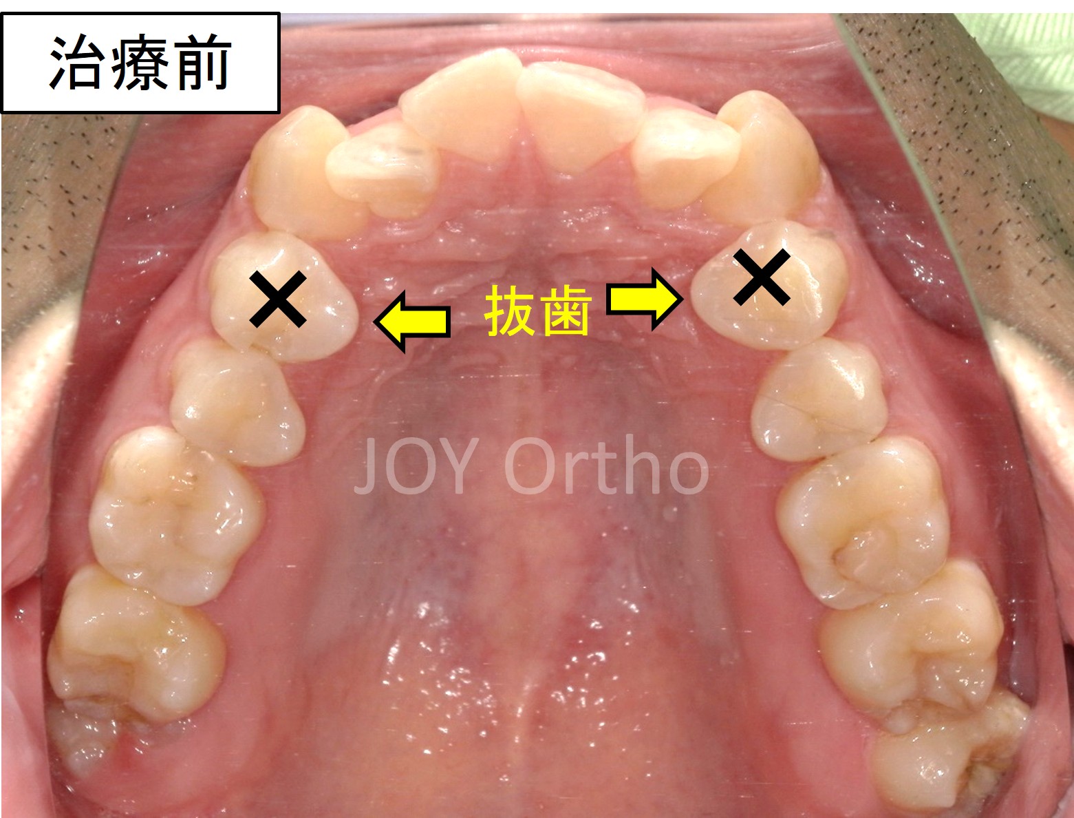 下顎6番抜歯前の口腔内写真。左下6番は保存困難で、親知らずは横向きに埋伏している