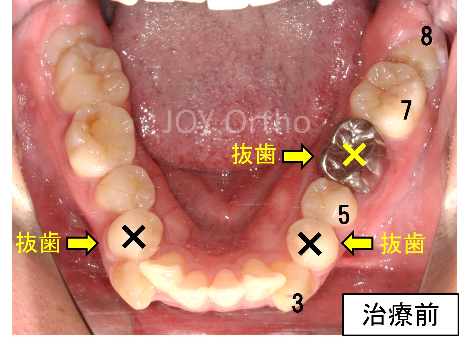 下顎6番抜歯前の口腔内写真。左下6番は保存困難で、親知らずは横向きに埋伏している