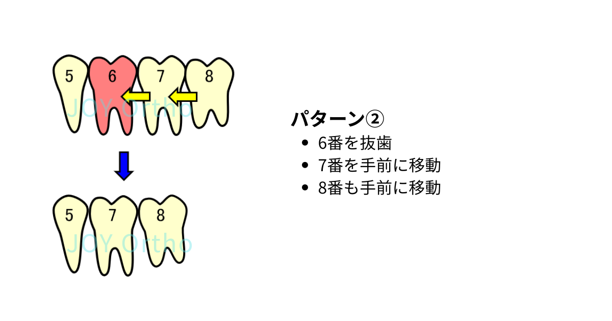 下顎6番を抜歯後、7番と親知らず（8番）を利用してインプラントを回避する矯正治療のパターン図①