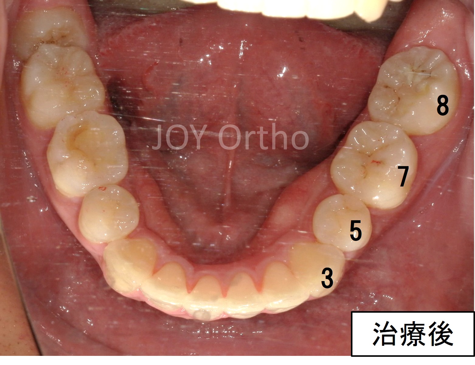 下顎6番抜歯後、7番と親知らずを利用してスペースを閉鎖し、インプラントを回避した治療後の口腔内写真