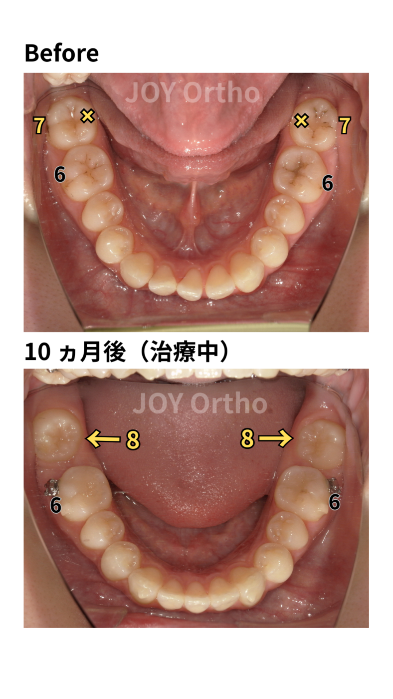 JOY矯正歯科クリニック 症例8 治療前後の下顎口腔内写真の比較。下顎左右7番が抜歯され、下顎左右8番が自然と萌出してきている。