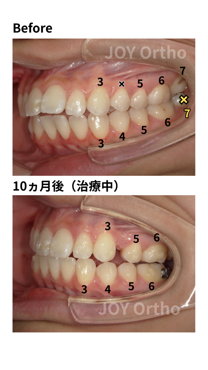 JOY矯正歯科クリニック 症例8 治療前後の左側口腔内写真の比較。左下7番が抜歯され、左下8番が萌出してきている。