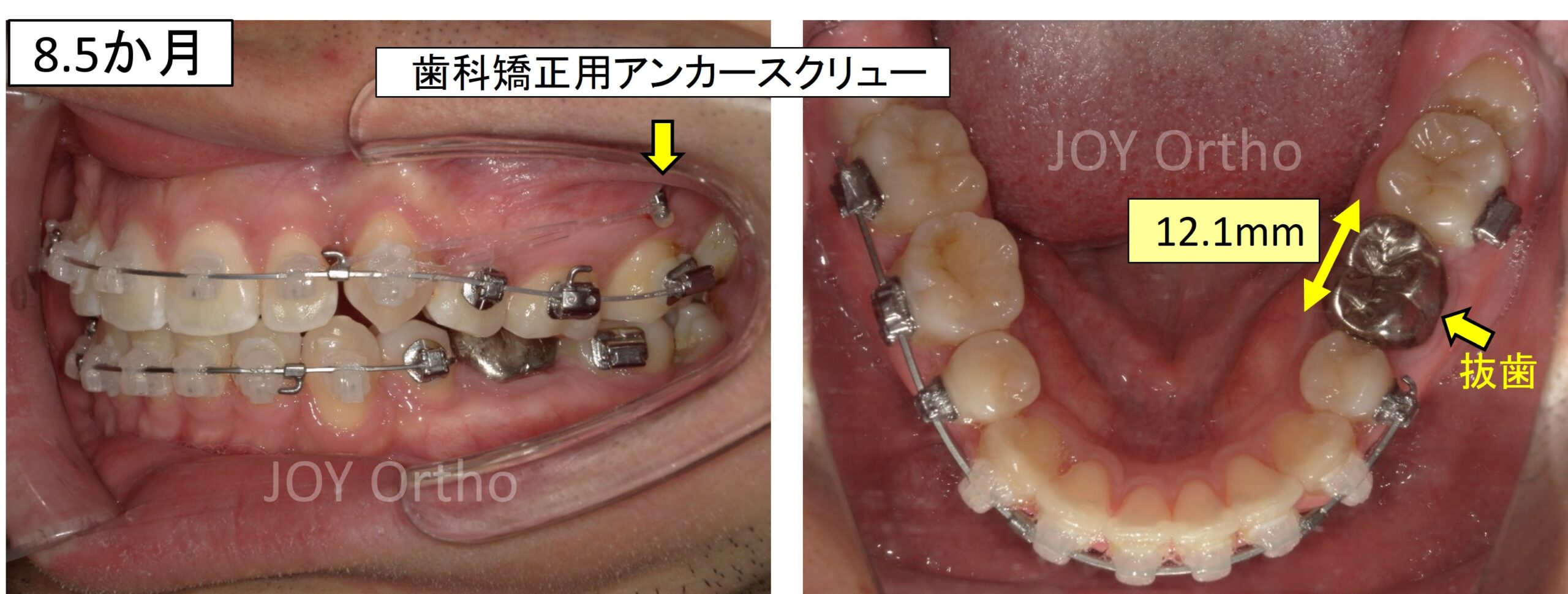 横向きに埋伏していた左下親知らず（8番）を矯正的に起こすために、6番を抜歯する直前の口腔内写真

