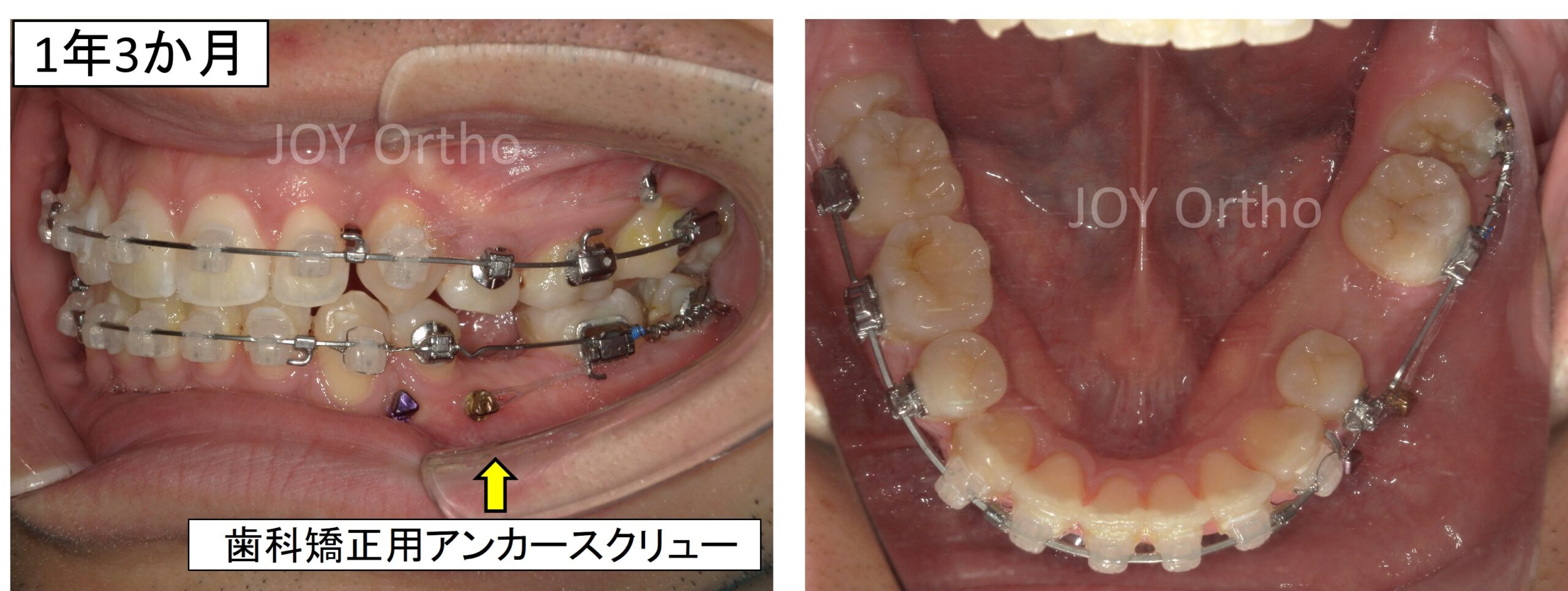 横向きに埋伏していた左下親知らず（8番）を矯正的に起こして歯列に誘導している途中の口腔内写真