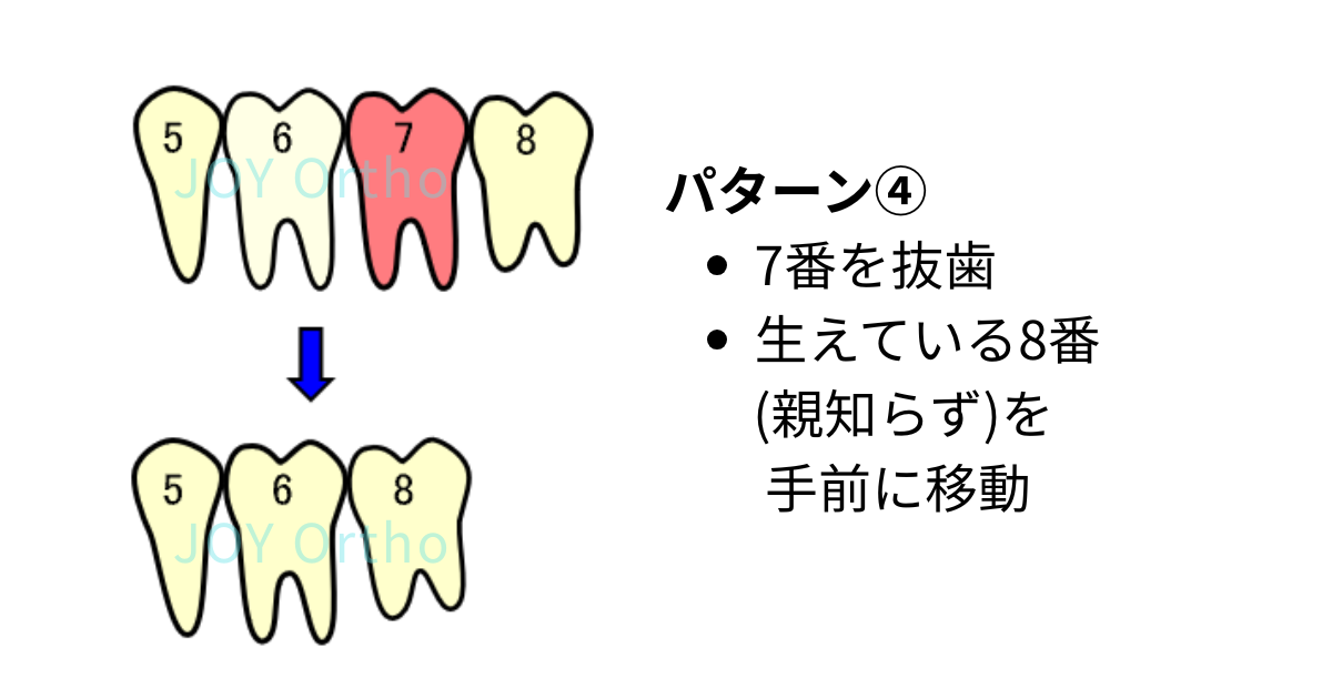 JOY矯正歯科クリニックのパターン④ 7番を抜歯して既に生えている親知らず(8番)を前方へ移動させる矯正治療の模式図