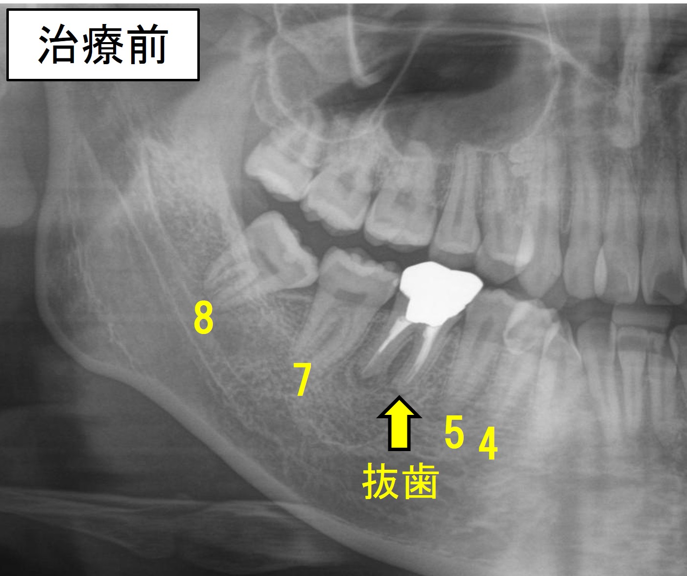 治療開始前のレントゲン写真。右下6番は根尖病巣があり、再治療が必要な状態。親知らずは上向きに生えている。