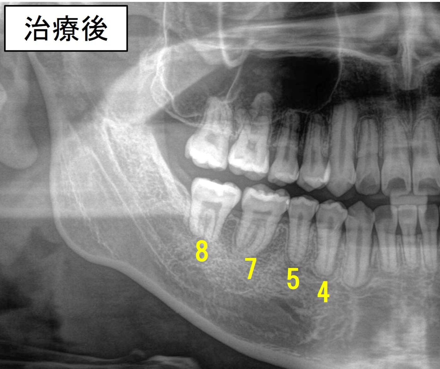 治療後のレントゲン写真。右下6番は抜歯され、右下7番・8番が傾斜することなく近心移動されている。
