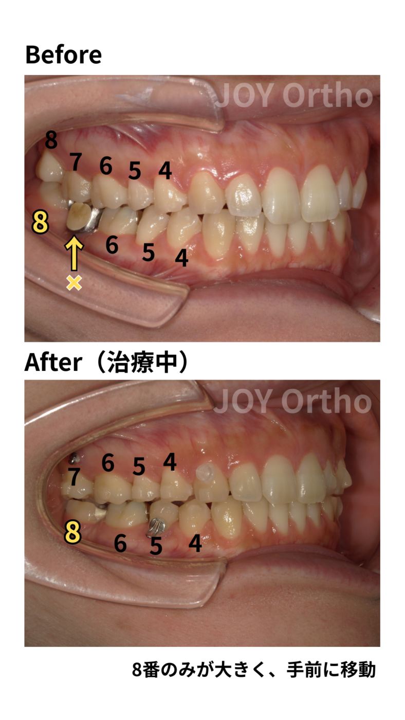 JOY矯正歯科クリニック 症例9 右下7番ブリッジ脱離でインプラント勧められたが8番を利用して矯正的にスペース閉鎖した治療前後の右側口腔内写真の比較。