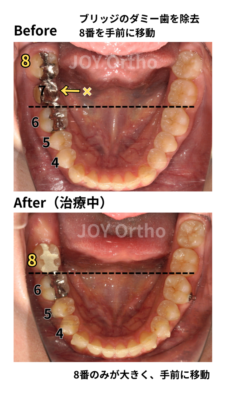 JOY矯正歯科クリニック 症例9 右下7番ブリッジ脱離でインプラント勧められたが8番を利用して矯正的にスペース閉鎖した治療前後の下顎口腔内写真の比較。