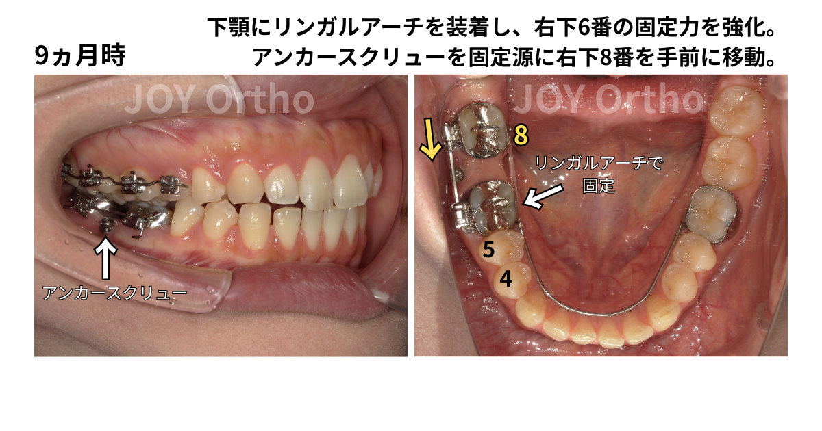 JOY矯正歯科クリニック 症例9 右下7番ブリッジ脱離でインプラント勧められたが8番を利用して矯正的にスペース閉鎖中の口腔内写真。アンカースクリューを固定源に右下8番を近心移動中。
