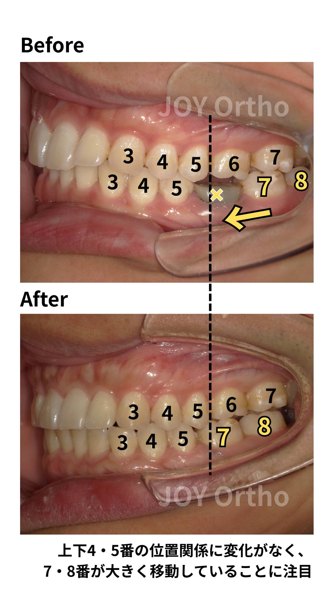 治療前後の口腔内写真。左上下の4・5番の位置関係が変化していないにも関わらず、左下7・8番が10mm以上近心移動している。