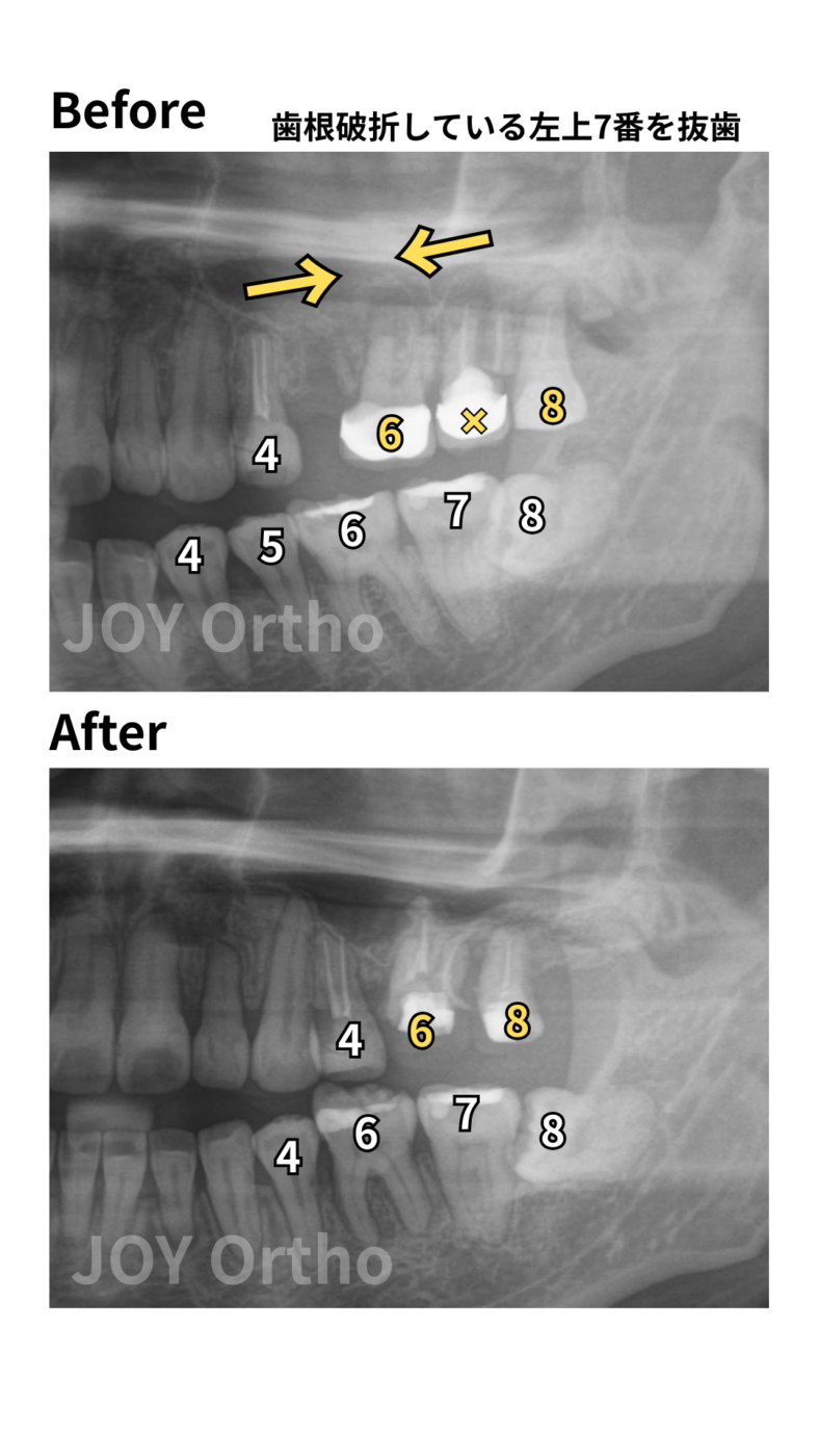 JOY矯正歯科クリニック 症例10 左上7番歯根破折で抜歯し、左上8番を利用してインプラント回避した症例の治療前後のレントゲン写真の比較。