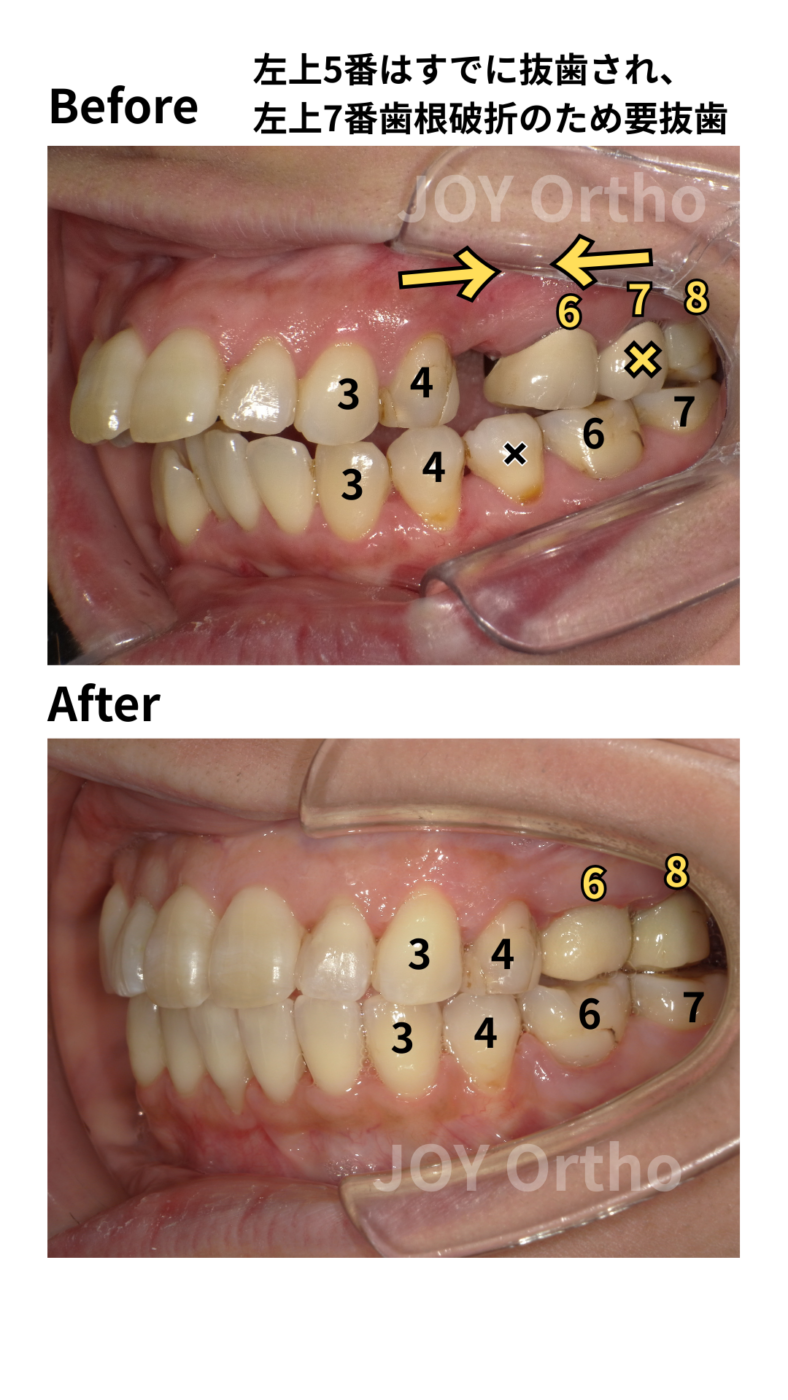JOY矯正歯科クリニック 症例10 左上7番歯根破折で抜歯し、左上8番を利用してインプラント回避した症例の左側口腔内写真の治療前後の比較