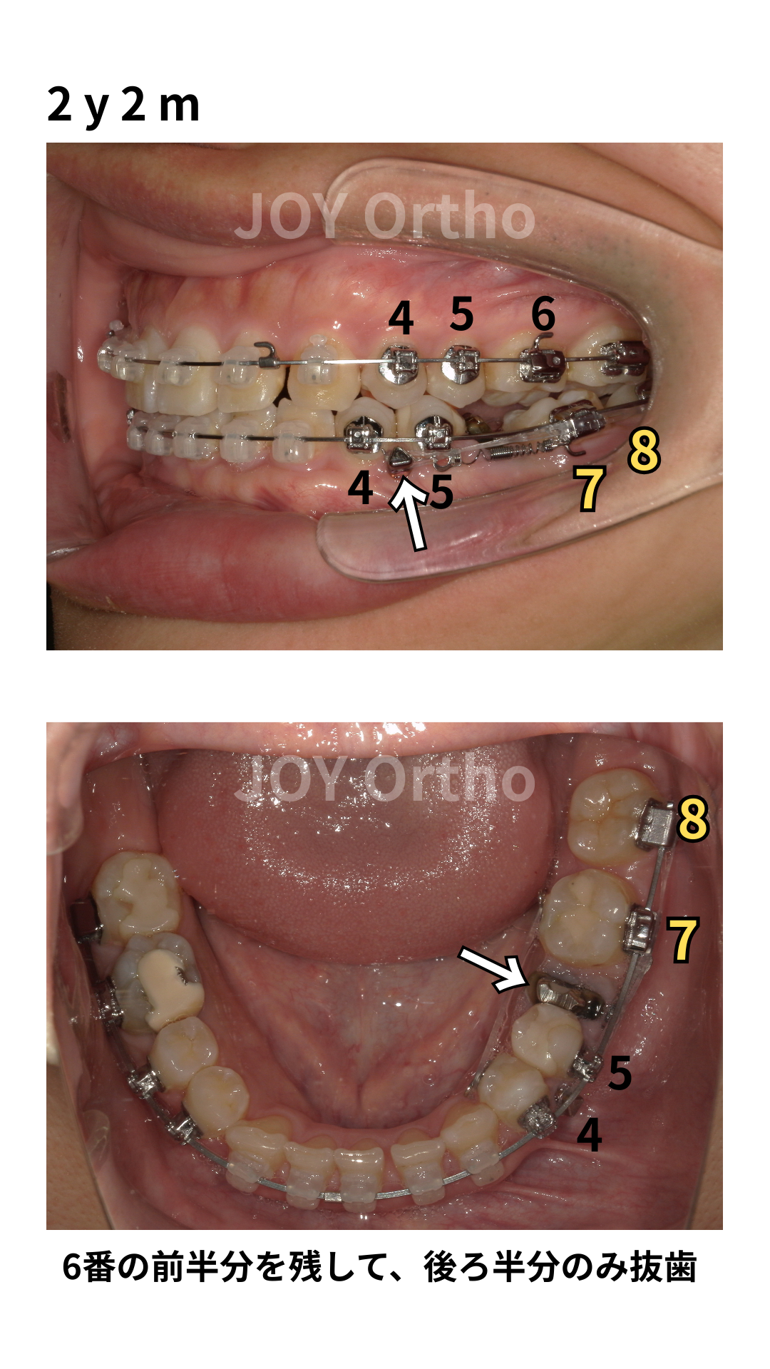 治療開始2年２か月時の口腔内写真。左下6番の近心根を残して、遠心根のみ抜歯して、左下7・8番を近心移動している。