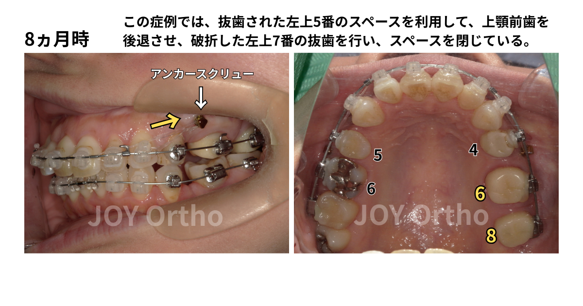 JOY矯正歯科クリニック 症例10 左上7番歯根破折で抜歯し、左上8番を利用してインプラント回避した症例の治療中の口腔内写真。アンカースクリューを使用してスペースを閉じている。