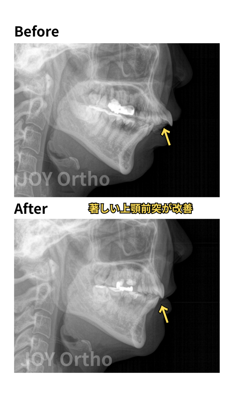 JOY矯正歯科クリニック 症例10 左上7番歯根破折で抜歯し、左上8番を利用してインプラント回避した症例のレントゲン写真(側面セファログラム)の治療前後の比較。著しい上顎前突が改善。