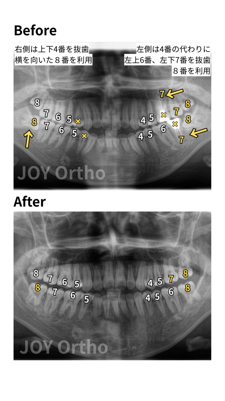 JOY矯正歯科クリニック 症例11 4番の代わりに6番や7番の根管治療歯を抜歯し、親知らず(8番)を活用して健全な歯のみで咬合再構築した治療前後のレントゲン写真の比較