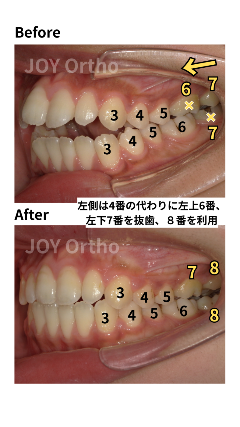 JOY矯正歯科クリニック 症例11 4番の代わりに6番や7番の根管治療歯を抜歯し、親知らず(8番)を活用して健全な歯のみで咬合再構築した治療前後の左側口腔内写真の比較