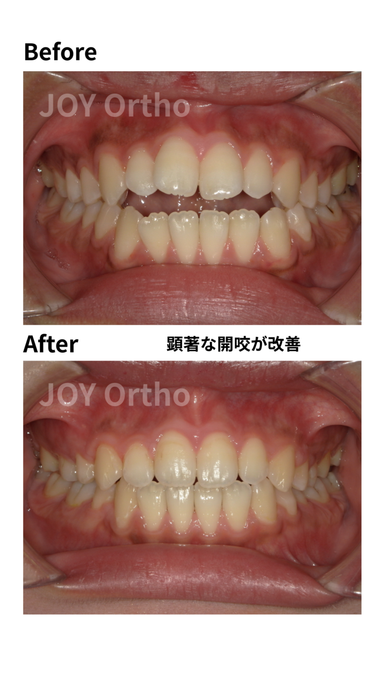 JOY矯正歯科クリニック 症例11 4番の代わりに6番や7番の根管治療歯を抜歯し、親知らず(8番)を活用して健全な歯のみで咬合再構築した治療前後の正面口腔内写真の比較