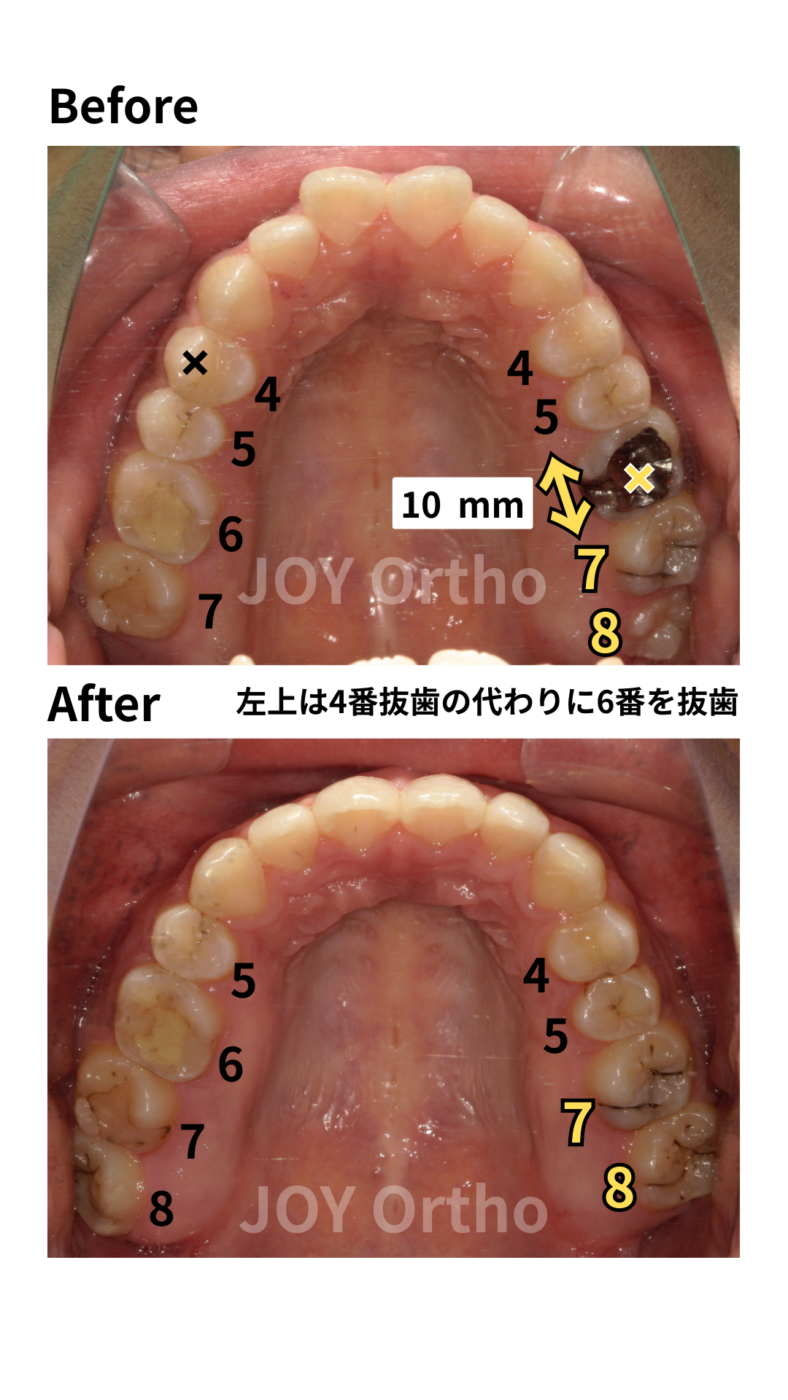 JOY矯正歯科クリニック 症例11 4番の代わりに6番や7番の根管治療歯を抜歯し、親知らず(8番)を活用して健全な歯のみで咬合再構築した治療前後の上顎口腔内写真の比較