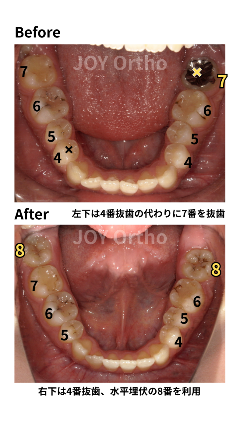 JOY矯正歯科クリニック 症例11 4番の代わりに6番や7番の根管治療歯を抜歯し、親知らず(8番)を活用して健全な歯のみで咬合再構築した治療前後の下顎口腔内写真の比較
