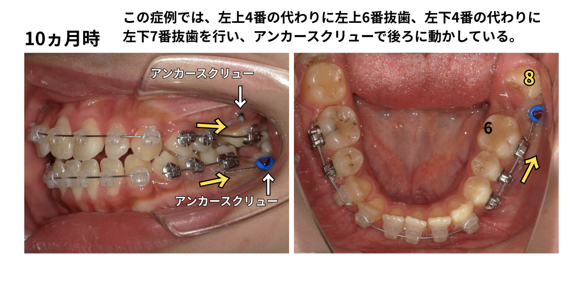 JOY矯正歯科クリニック 症例11 4番の代わりに6番や7番の根管治療歯を抜歯し、親知らず(8番)を活用して健全な歯のみで咬合再構築した治療中の口腔内写真。アンカースクリューを使用して歯を遠心移動している。