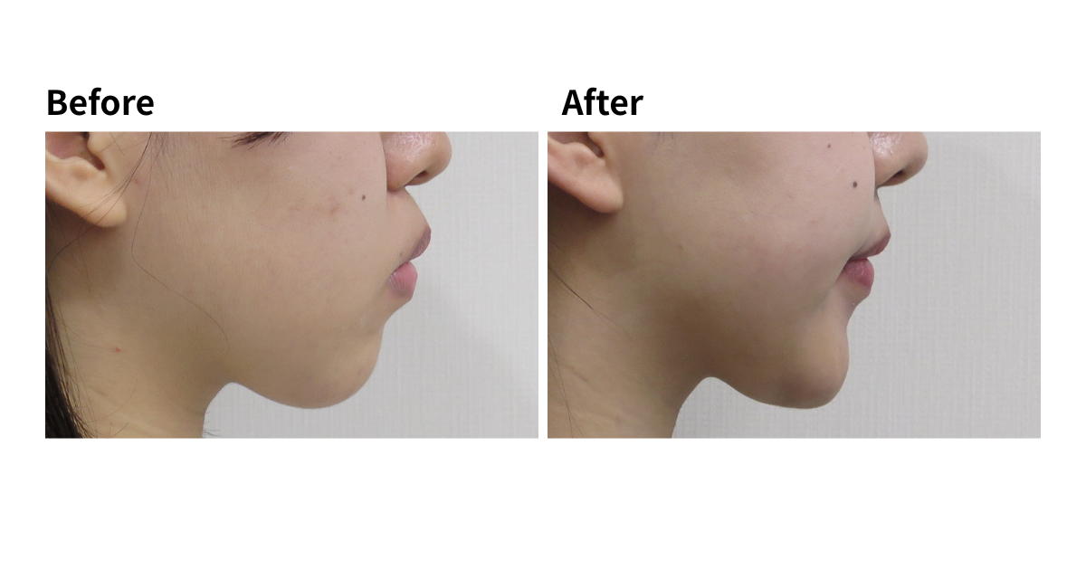 JOY矯正歯科クリニック 症例11 4番の代わりに6番や7番の根管治療歯を抜歯し、親知らず(8番)を活用して健全な歯のみで咬合再構築した治療前後の顔貌、口元の変化。きれいなEラインが得られ、口呼吸が改善。