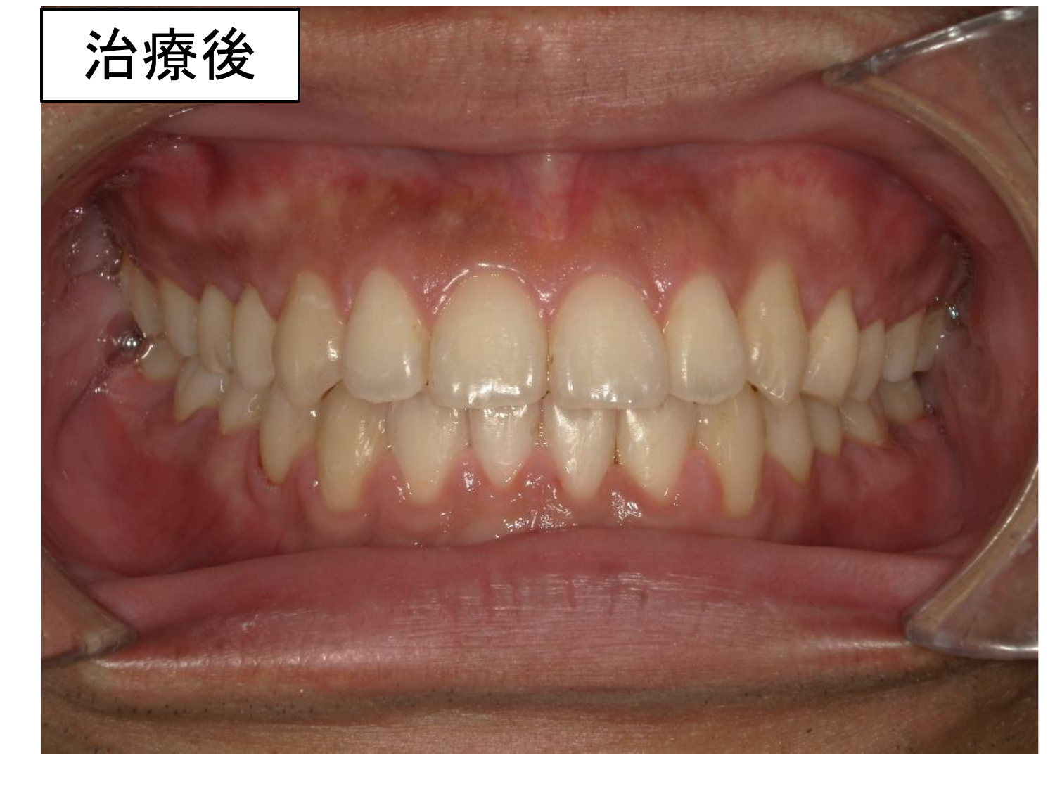 治療後の口腔内写真。
非抜歯できれいに排列されている。