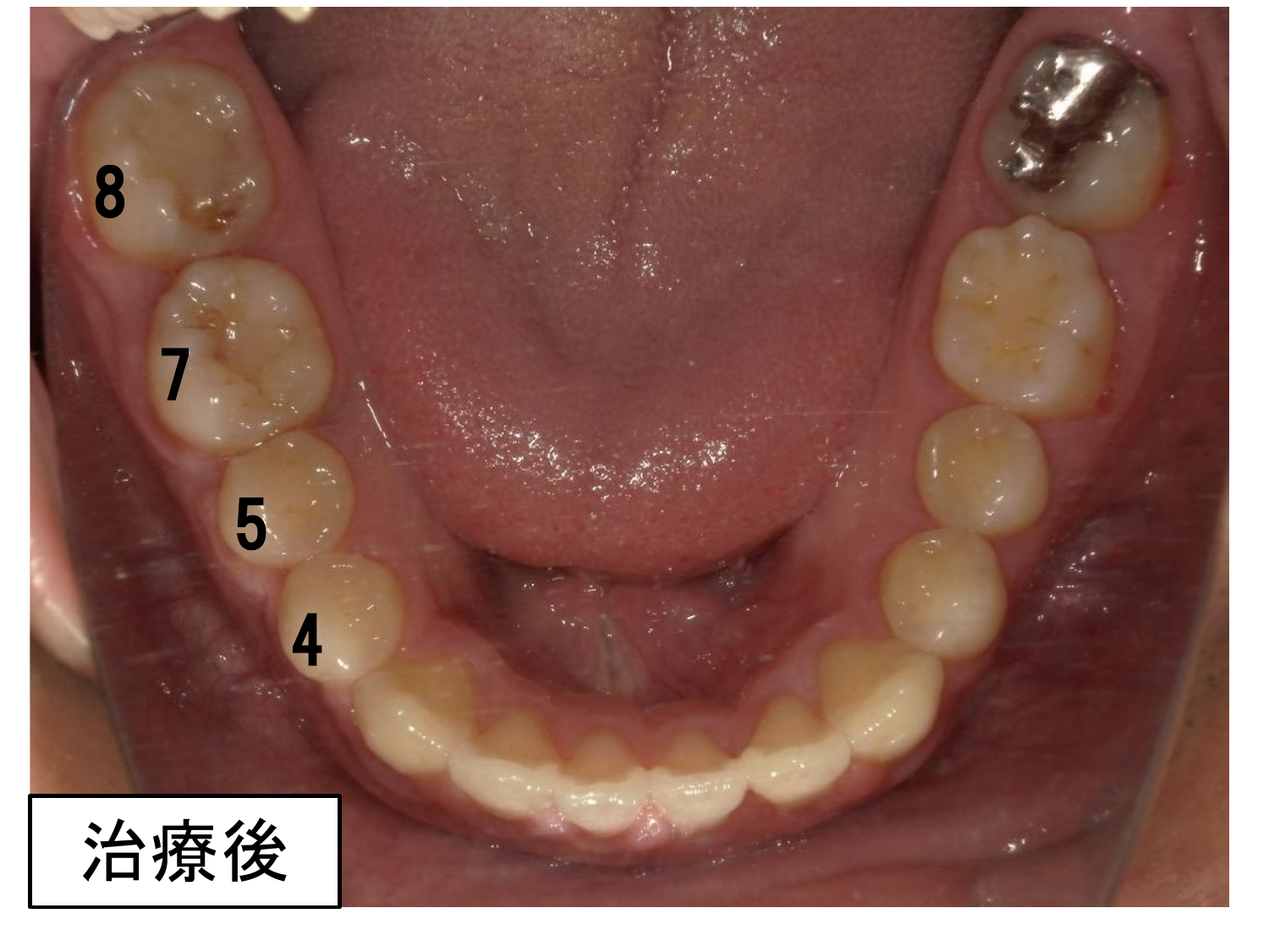 治療後の口腔内写真。右下6番は抜歯され、右下7番・8番が大きく近心移動されている。