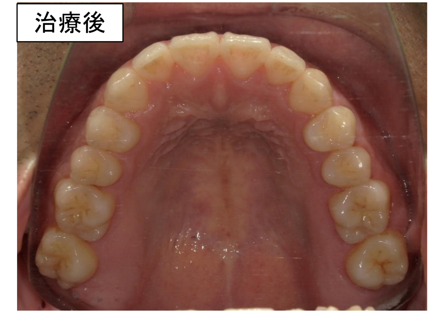 治療後の口腔内写真。
非抜歯できれいに排列されている。