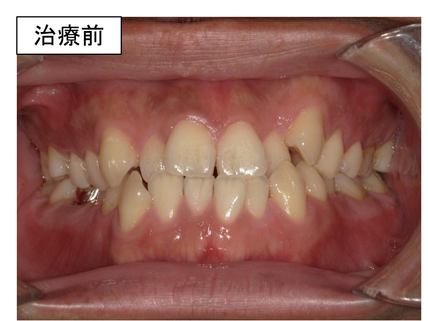 治療前の口腔内写真。前歯部叢生を認め、一部反対咬合を認める。