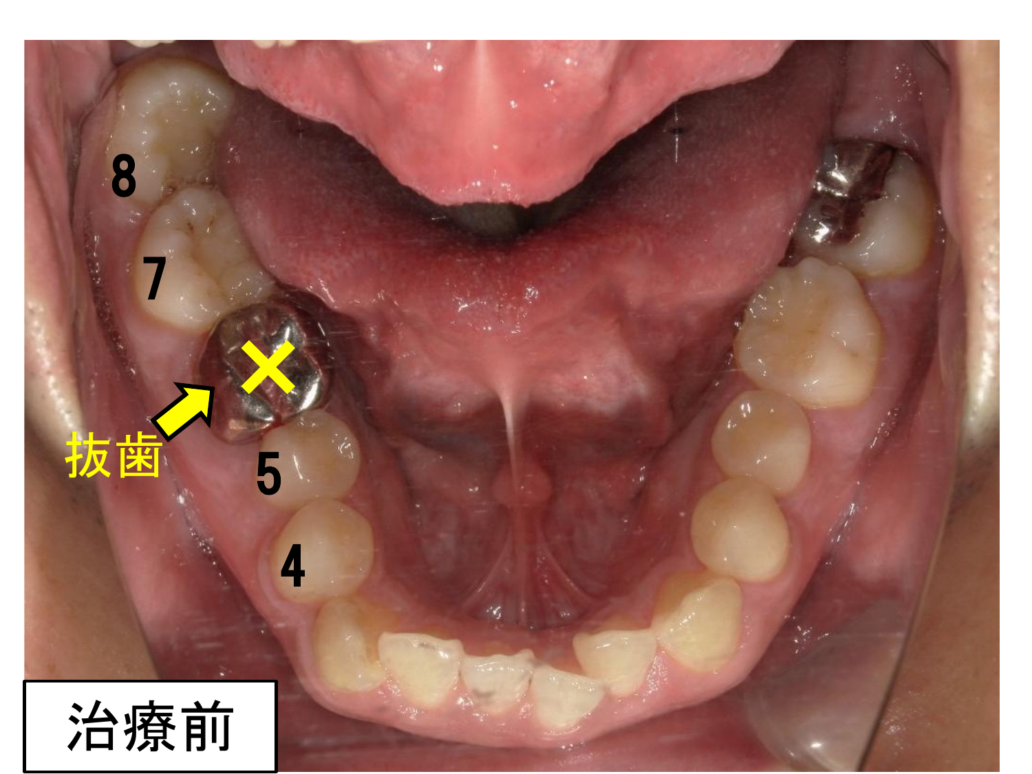 治療前の口腔内写真。右下6番は根治歯、根尖病巣があり再治療が必要なため抜歯し、右下7番・8番を近心移動させる。